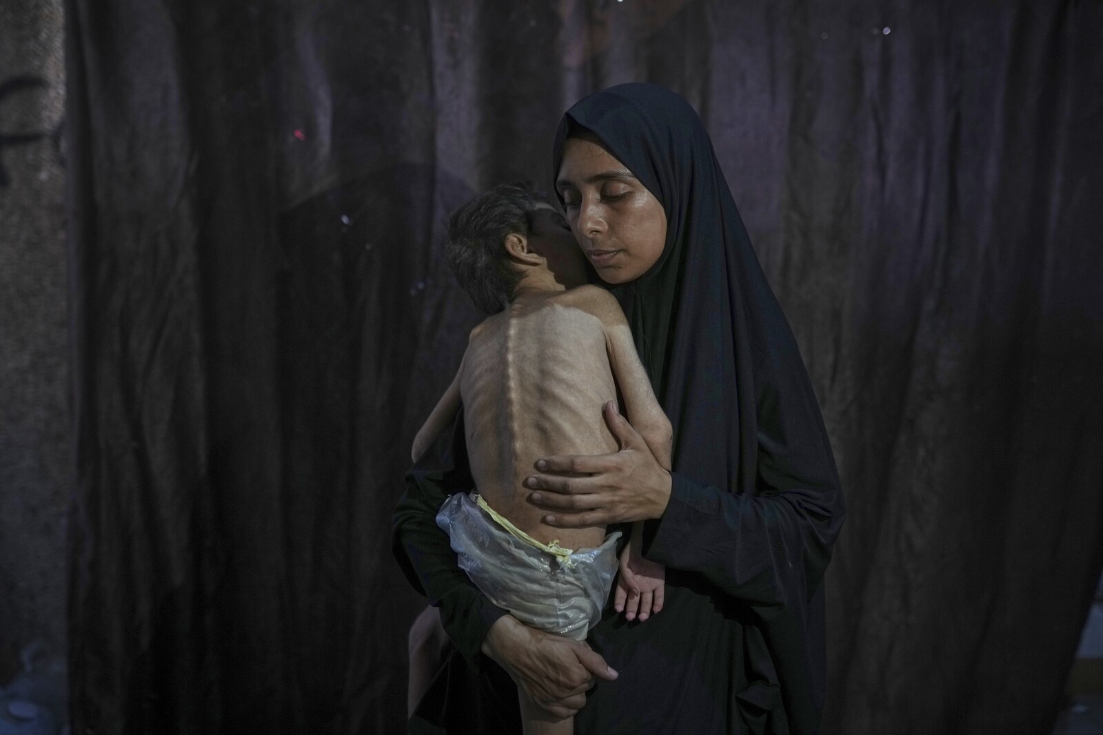 Hunger Crisis in Gaza: Malnutrition