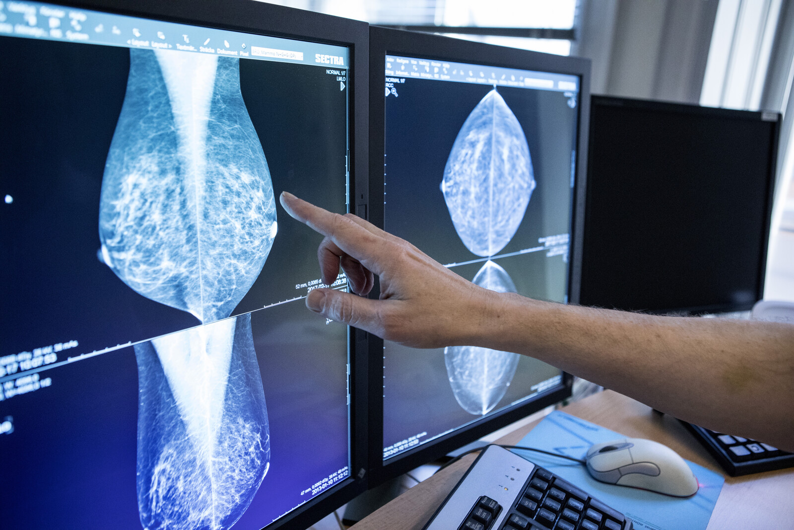 Success when AI detects breast