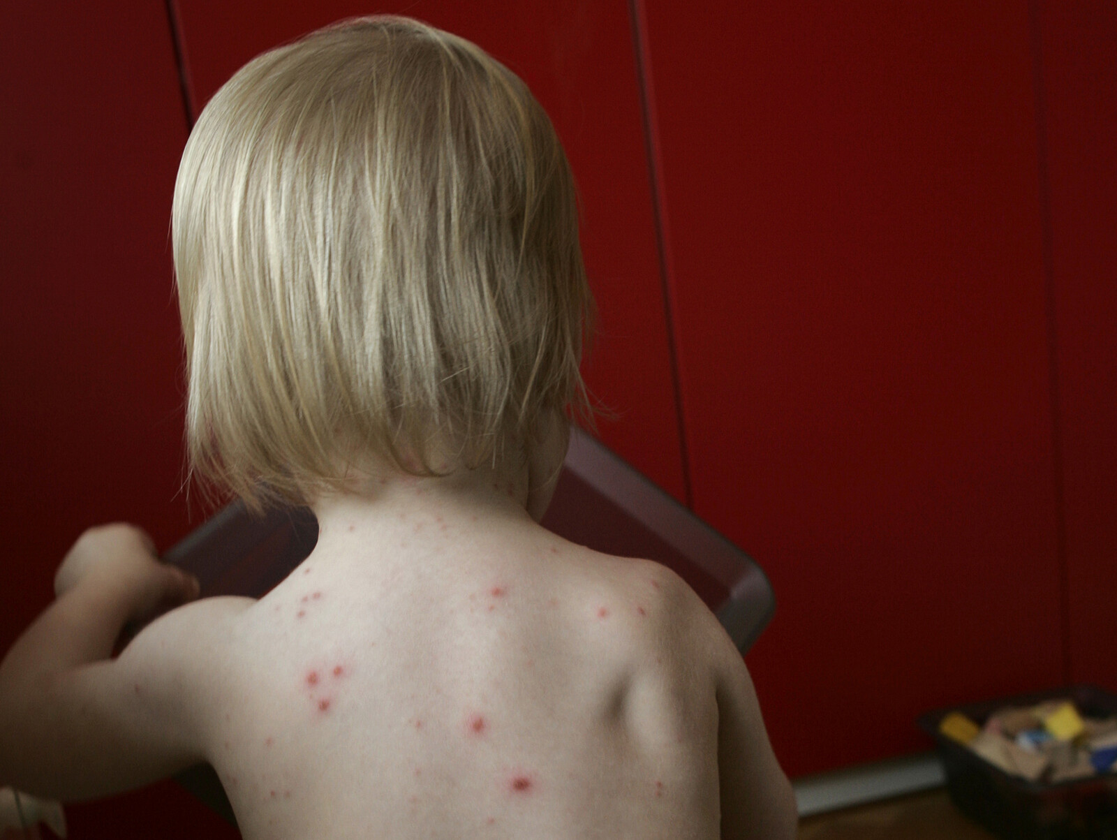 Government Plans to Add Chickenpox Vaccine to Child Vaccination Program