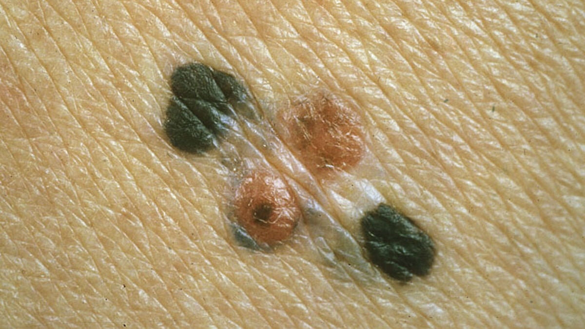 Moderna shares surge after positive melanoma vaccine study