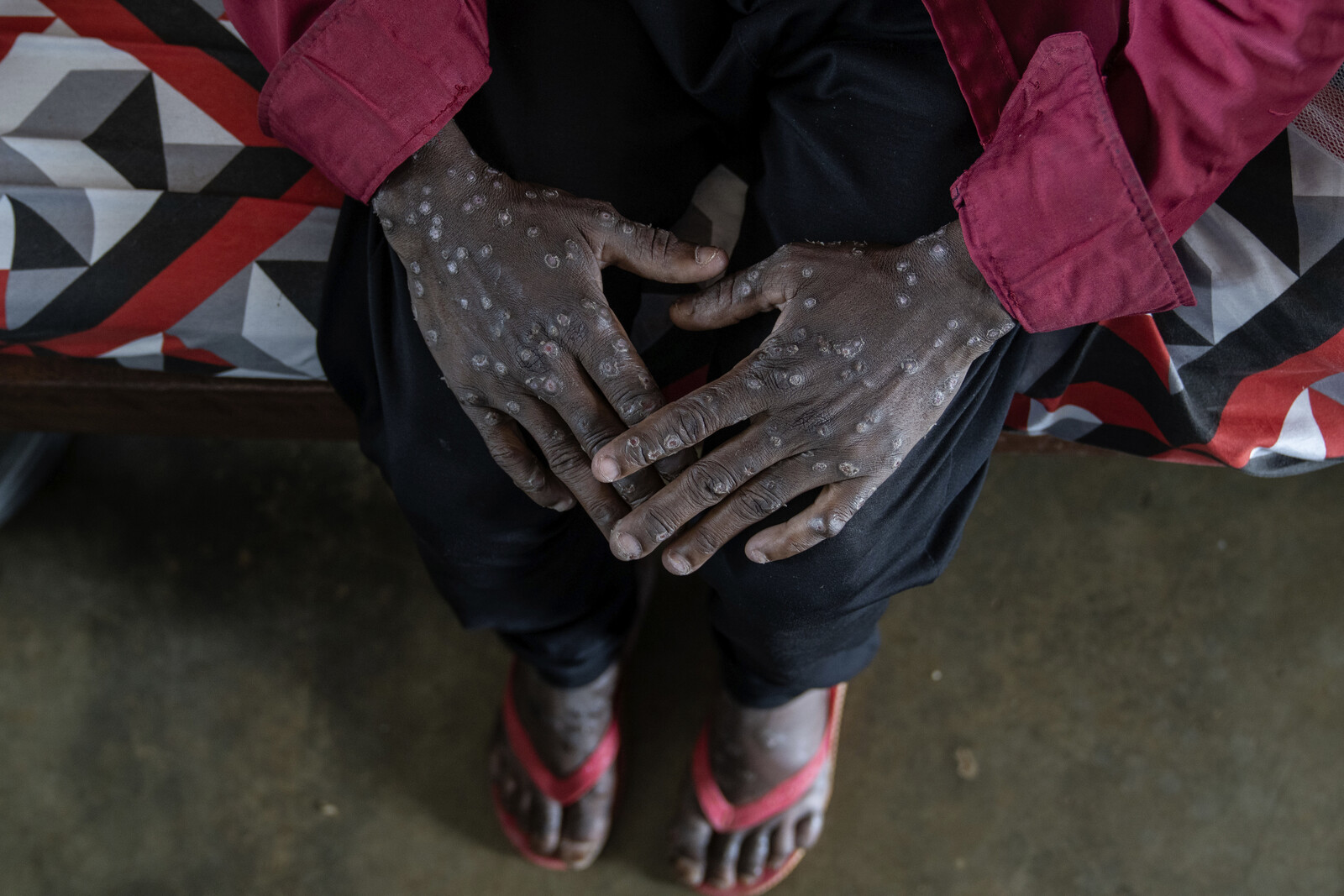 The spread of mpox slows