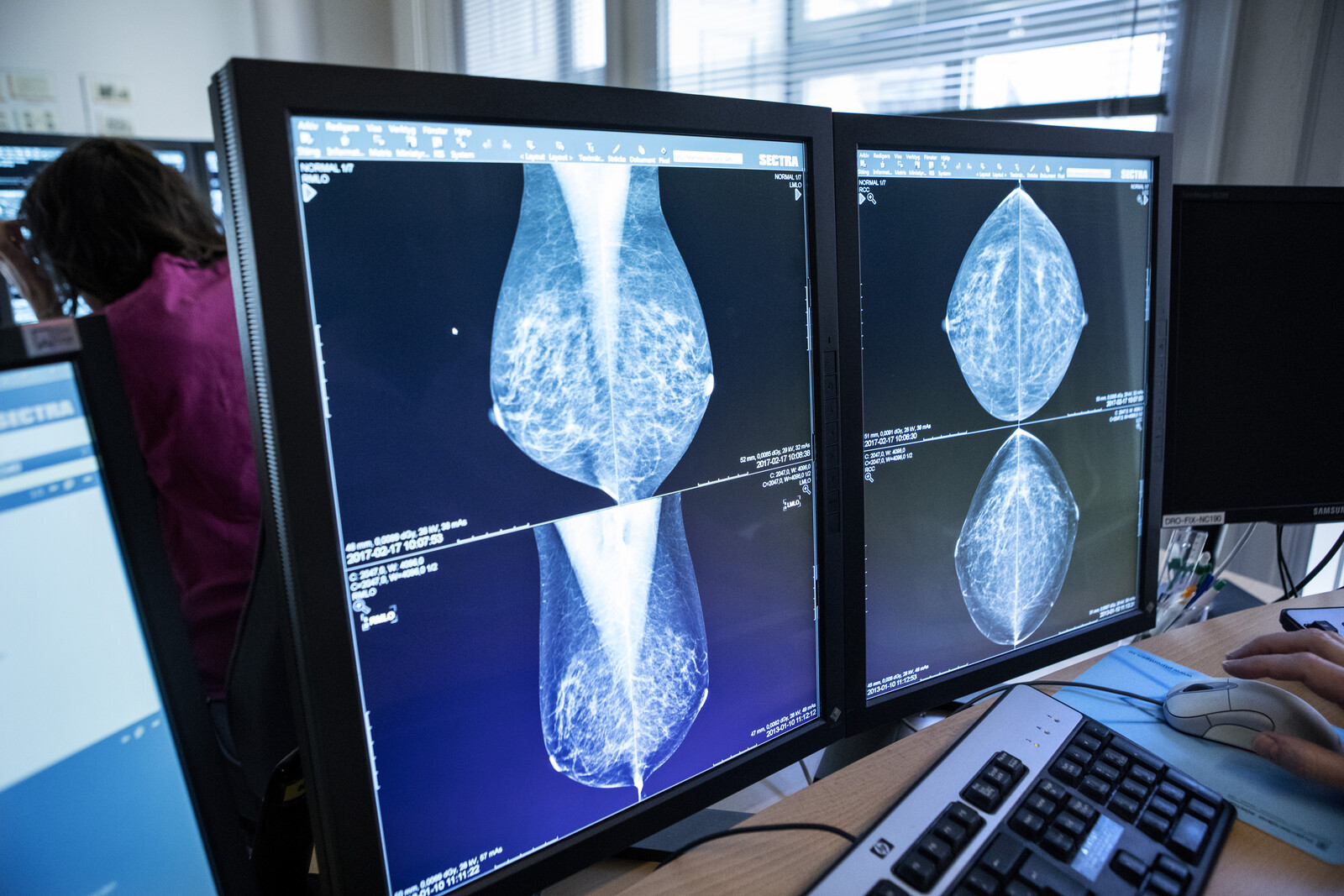 Breast Cancer Screening Software Flaw: Are You Affected?