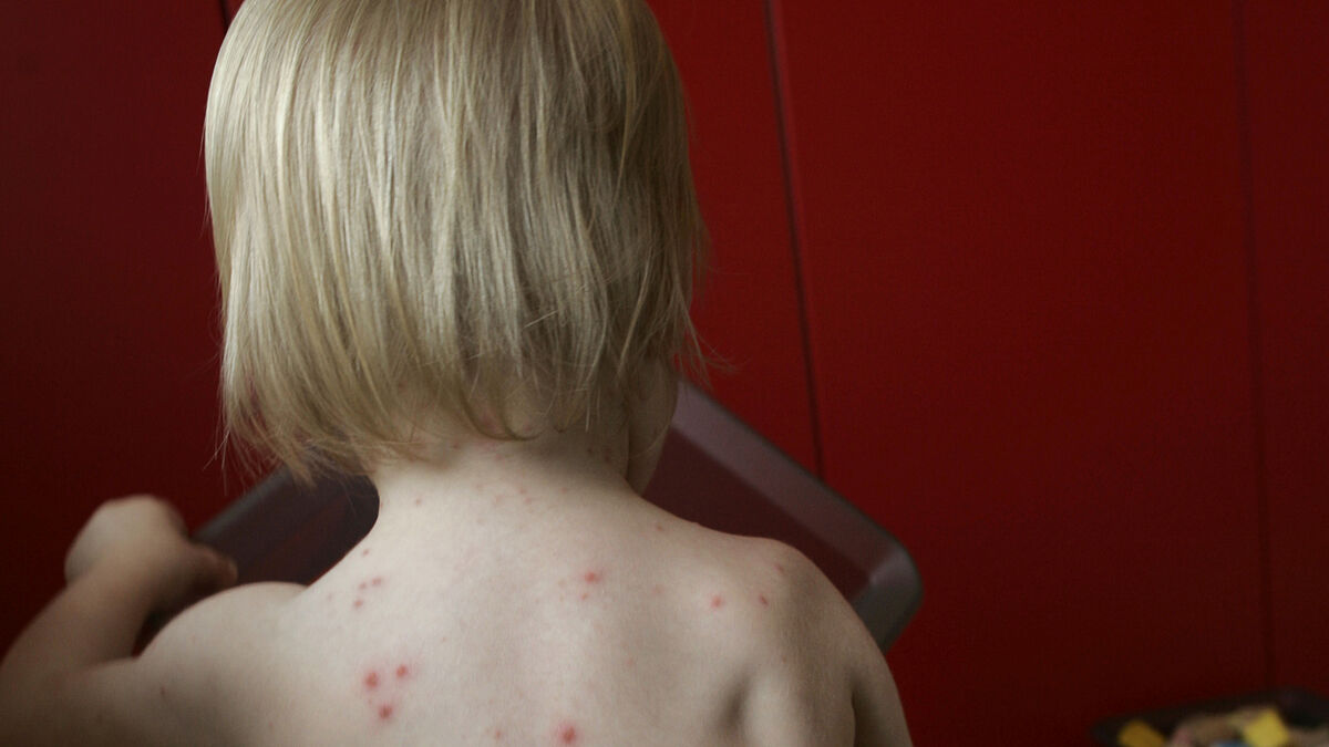 Free chickenpox vaccine for children to be added to Sweden’s vaccination programme