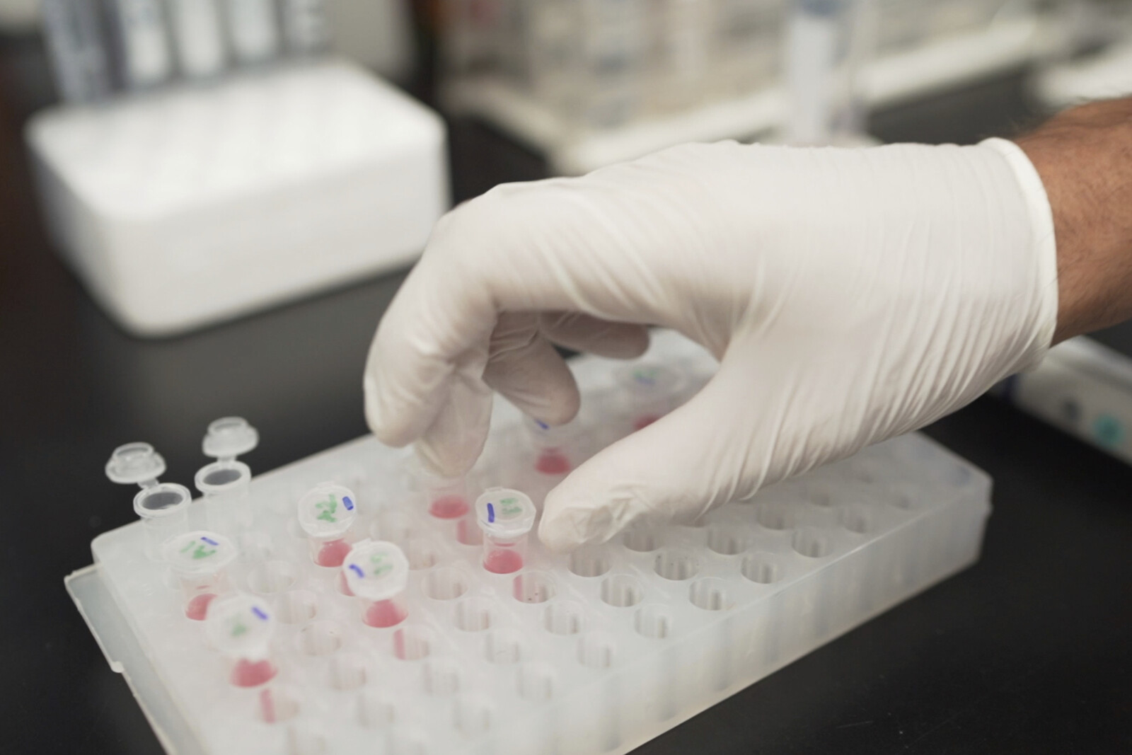 New Alzheimer's-Parkinson's Hybrid Disease Discovered by Swedish Researchers